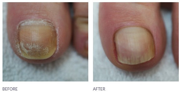 Footlogix #11 Cuticle Softener - 118 ml