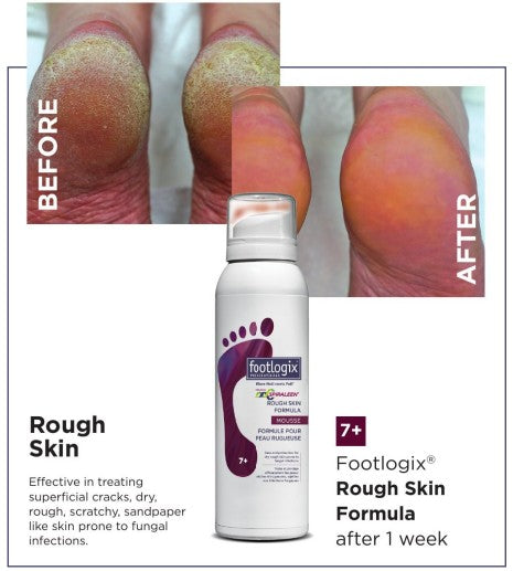 Footlogix #7+ Rough Skin Formula with Spiraleen (contact us for professional pricing)