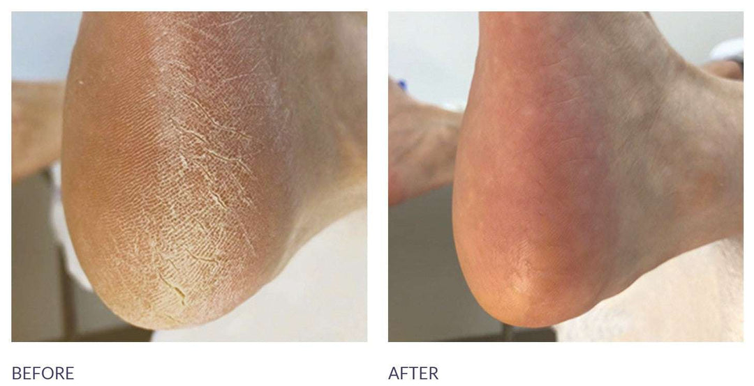 Footlogix At home foot care combo - callus softener (100 ml ) and exfoliating foot file (contact us for professional pricing)