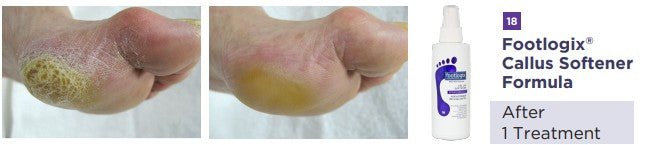 Footlogix 18 Callus softener concentrate - professional sizes in 180 ml and 946 ml - U - tools