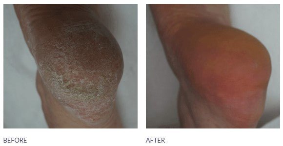 Footlogix 18 Callus softener concentrate - professional sizes in 180 ml and 946 ml - U - tools