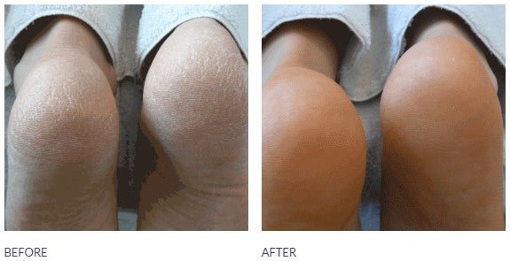 Footlogix 3 Very Dry Skin Formula - Footlogix - U - tools