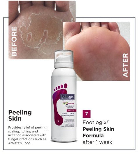 Footlogix 7 Peeling Skin Formula with Spiraleen - Footlogix - U - tools