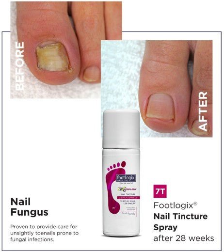 Footlogix 7T Nail Tincture Spray with Spiraleen - Footlogix - U - tools